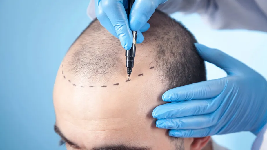 کاشت مو در کلینیک زیبایی ارومیه