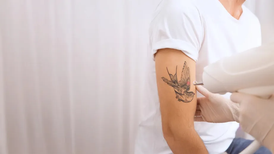 پاک کردن تتو در کلینیک زیبایی ارومیه