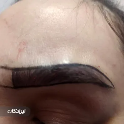 مرکز کاشت مو شیما