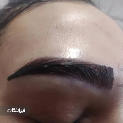 مرکز کاشت مو شیما