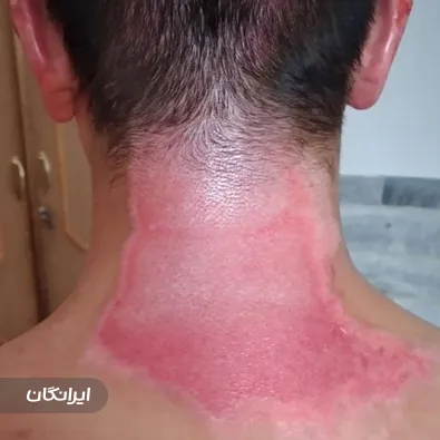 درمانگر زخم داود حسنلو