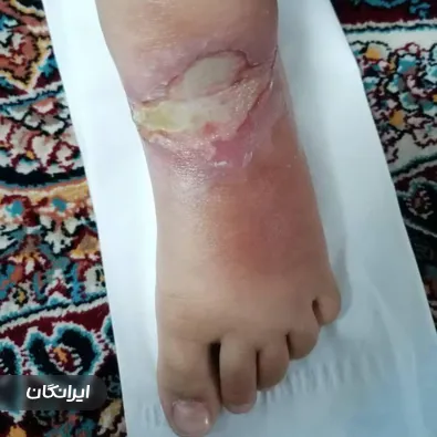 درمانگر زخم داود حسنلو