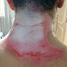 درمانگر زخم داود حسنلو