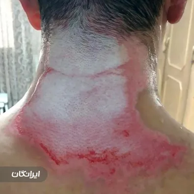 درمانگر زخم داود حسنلو