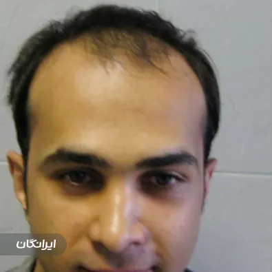 کلینیک کاشت مو و ابرو بوژان