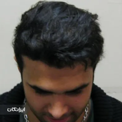 کلینیک کاشت مو و ابرو بوژان