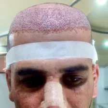 کلینیک کاشت مو قربانی