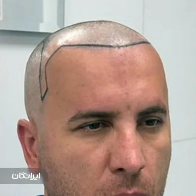 کلینیک کاشت مو ترلان رزم