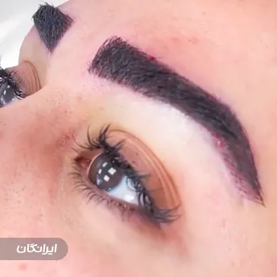 مرکز کاشت مو دنیز