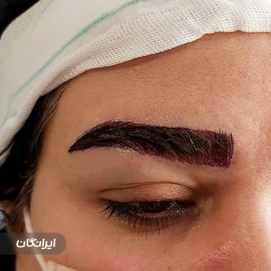 مرکز کاشت مو دنیز