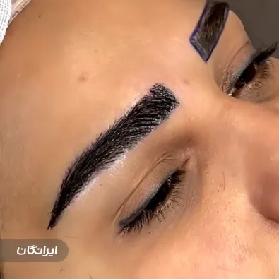 کلینیک کاشت مو کمون