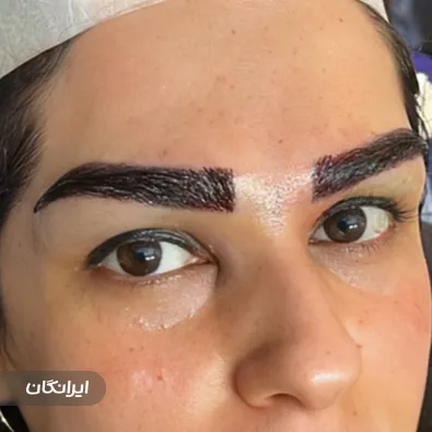 کلینیک کاشت مو کمون