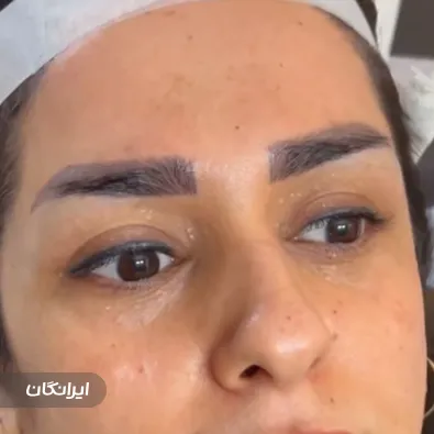 کلینیک کاشت مو کمون