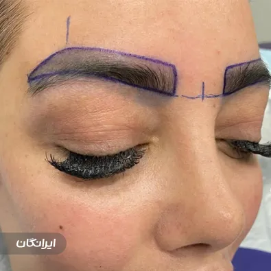 کلینیک کاشت مو برسا