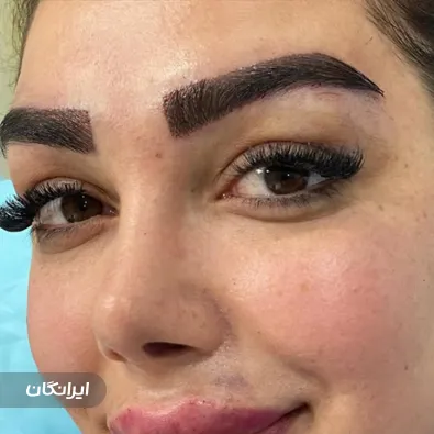 کلینیک کاشت مو برسا