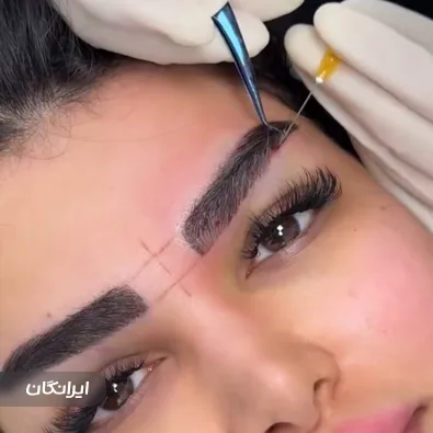 کلینیک کاشت مو کارن