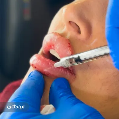 کلینیک کاشت مو صدرا