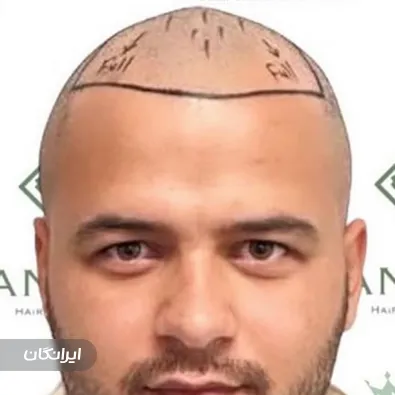 کلینیک کاشت مو احمدی