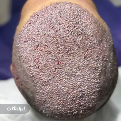 کارشناس کاشت مو سمیه رضایی