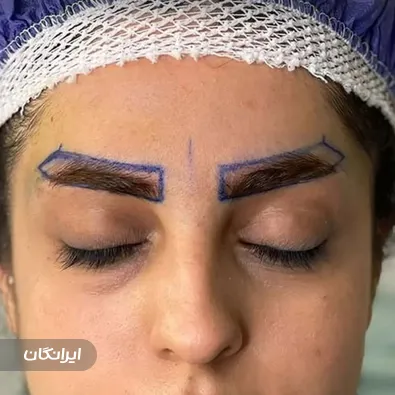 کلینیک کاشت مو شیروانی