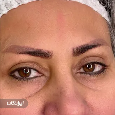 کلینیک کاشت مو بهاره