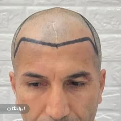 کلینیک کاشت مو بهروزی