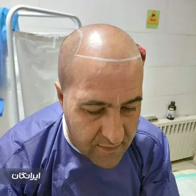 کارشناس کاشت مو چنور مرادی