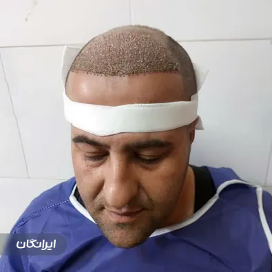 کارشناس کاشت مو چنور مرادی