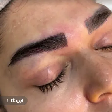 کلینیک کاشت موی مو ایران