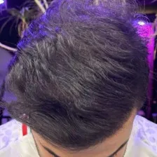 کلینیک کاشت مو سما