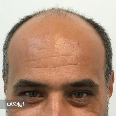 کلینیک کاشت مو رستا