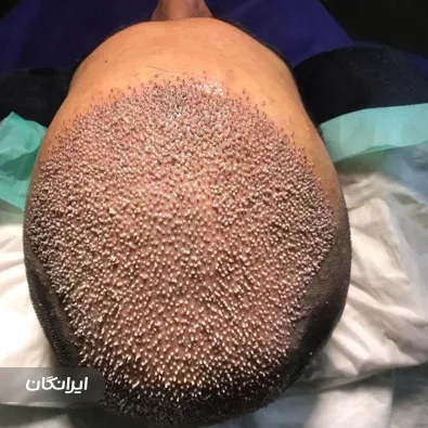 کلینیک کاشت مو رستا