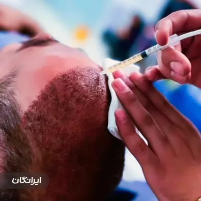 کارشناس کاشت مو مهدی سلطانی