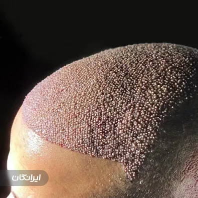 کارشناس کاشت مو مهدی سلطانی