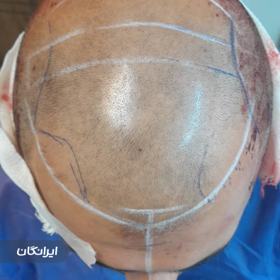 کارشناس کاشت مو سارا موذن