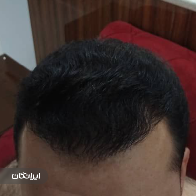 کارشناس کاشت مو سارا موذن