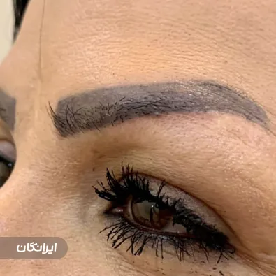 کلینیک کاشت مو نادیا