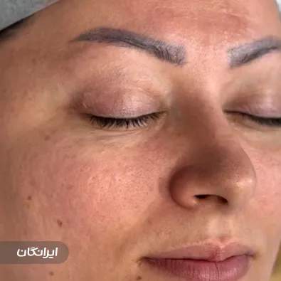 کارشناس کاشت مو یونس بهمنی