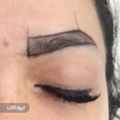 کلینیک کاشت مو رویان