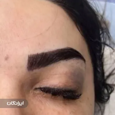 کلینیک کاشت مو رویان