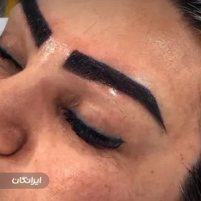 کلینیک کاشت مو شکیل