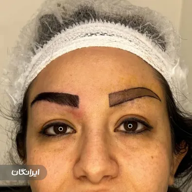 کلینیک کاشت ابرو و مو هیرتاک