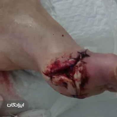 درمان زخم مصطفی گوهری