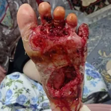 درمان زخم مصطفی گوهری