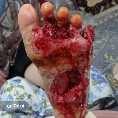 درمان زخم مصطفی گوهری