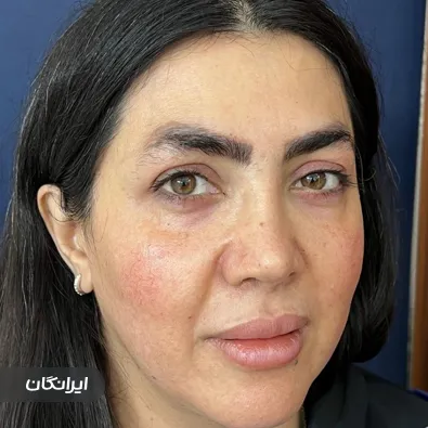 کاشت ابرو نسیم تشکری