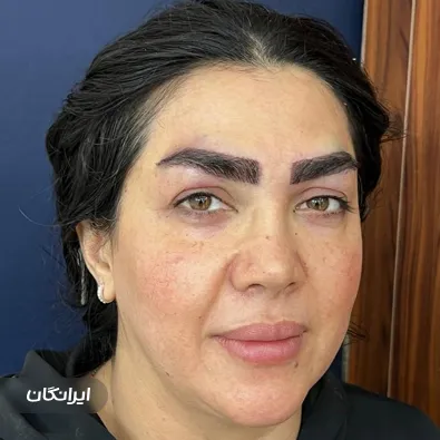 کاشت ابرو نسیم تشکری