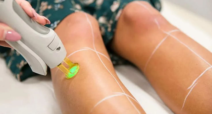 لیزر موهای زائد