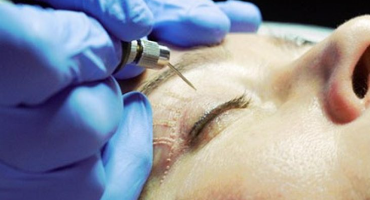 جراحی زیبایی پلک